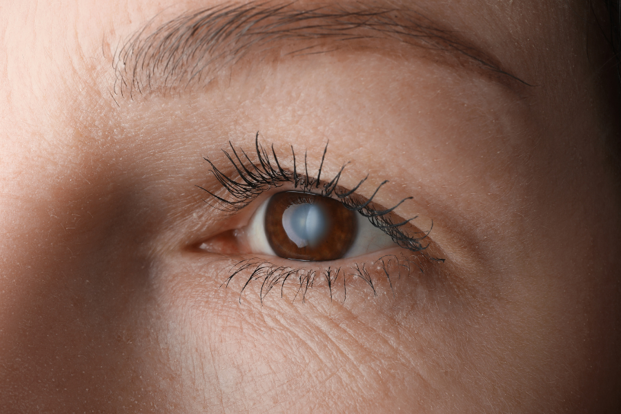 Zaćma wrodzona u dorosłego - objawy, przyczyny i leczenie