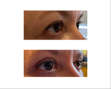 Blefaroplastyka powiek górnych