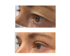 Blefaroplastyka powiek górnych