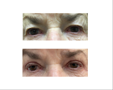 Blefaroplastyka powiek górnych