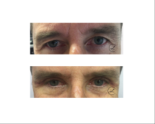 Blefaroplastyka powiek górnych