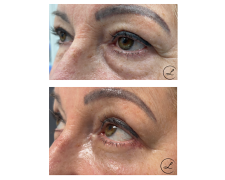 Blefaroplastyka powiek dolnych